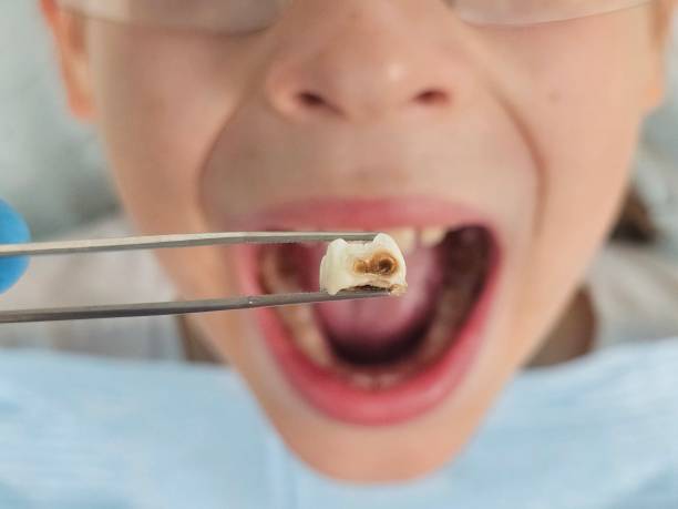 Best Emergency Dental Care for Broken or Chipped Teeth in Attla, AL